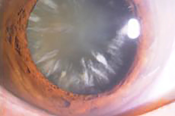 眼の中の水晶体が濁った状態