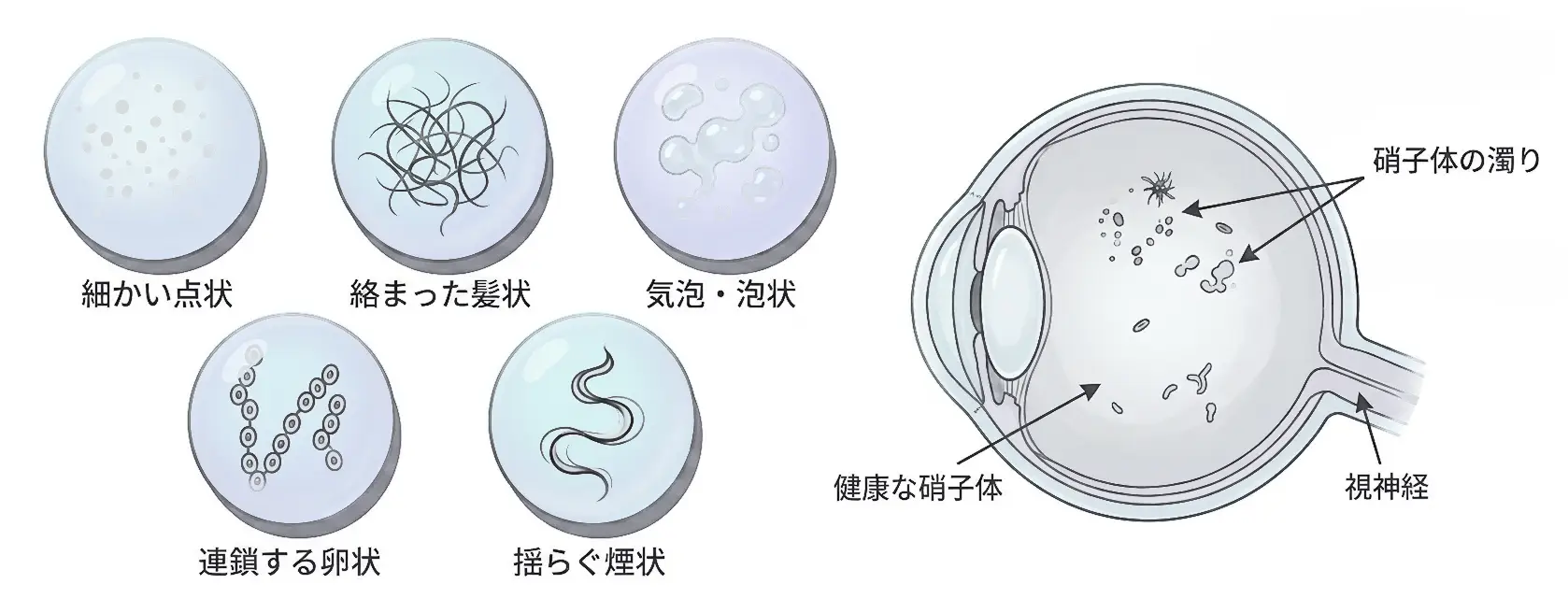 飛蚊症の見え方を示すイメージ