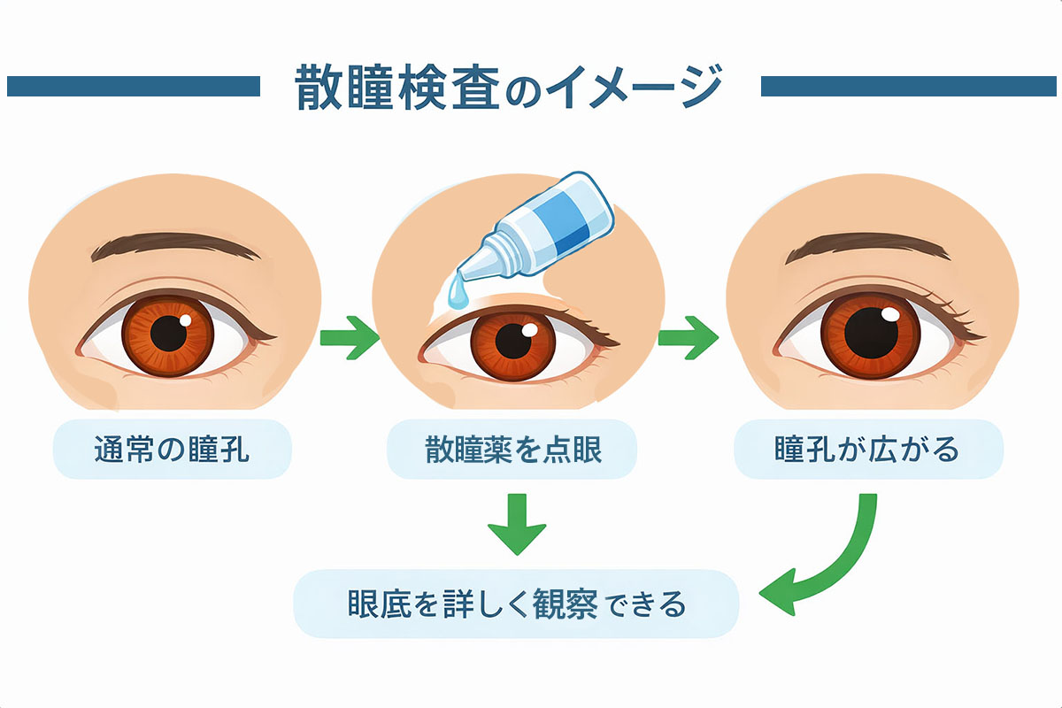散瞳検査のイメージ図