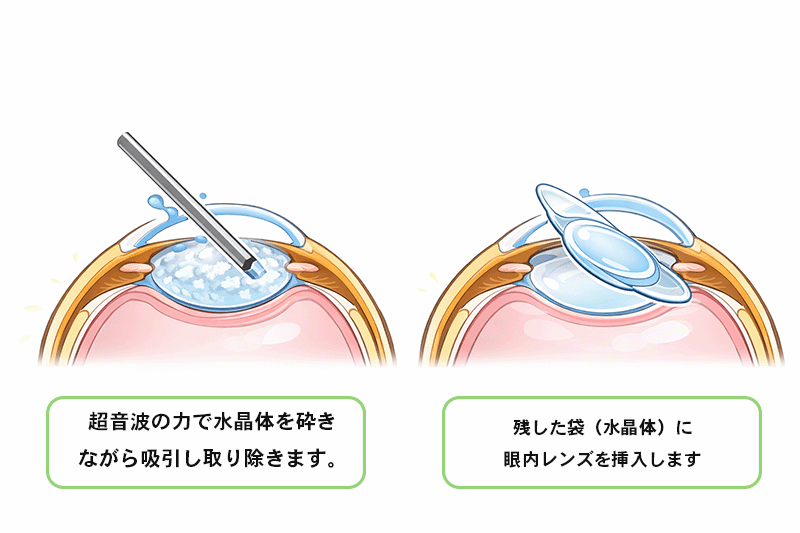 白内障の手術のイメージ